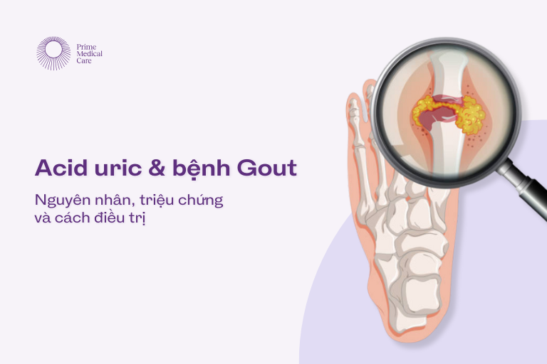 Acid Uric Gout Gút