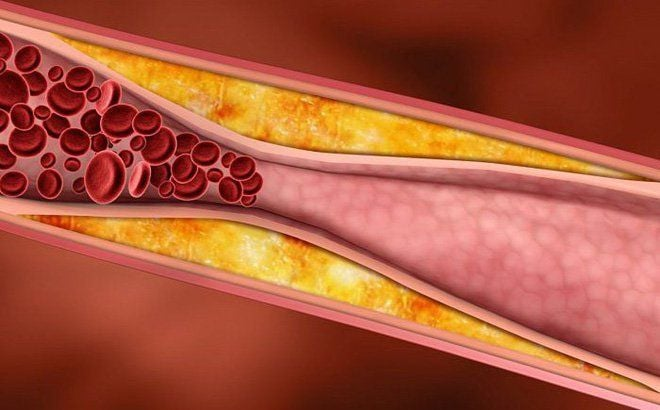 Rối loạn chuyển hoá lipid
Nguyên nhân rối loạn lipid máu
Triệu chứng rối loạn lipid máu
Điều trị rối loạn mỡ máu
Chế độ ăn cho người rối loạn mỡ máu
Bệnh mạch vành do cholesterol cao
Tác hại của LDL cholesterol
HDL cholesterol là gì
Mỡ máu cao có nguy hiểm không
Các yếu tố nguy cơ tăng mỡ máu
Chỉ số mỡ máu bình thường
Tăng triglyceride
Kiểm soát cholesterol máu
Xét nghiệm lipid máu
Thuốc điều trị rối loạn lipid máu
Rối loạn lipid máu nên ăn gì