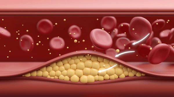 Rối loạn chuyển hoá lipid
Nguyên nhân rối loạn lipid máu
Triệu chứng rối loạn lipid máu
Điều trị rối loạn mỡ máu
Chế độ ăn cho người rối loạn mỡ máu
Bệnh mạch vành do cholesterol cao
Tác hại của LDL cholesterol
HDL cholesterol là gì
Mỡ máu cao có nguy hiểm không
Các yếu tố nguy cơ tăng mỡ máu
Chỉ số mỡ máu bình thường
Tăng triglyceride
Kiểm soát cholesterol máu
Xét nghiệm lipid máu
Thuốc điều trị rối loạn lipid máu
Rối loạn lipid máu nên ăn gì